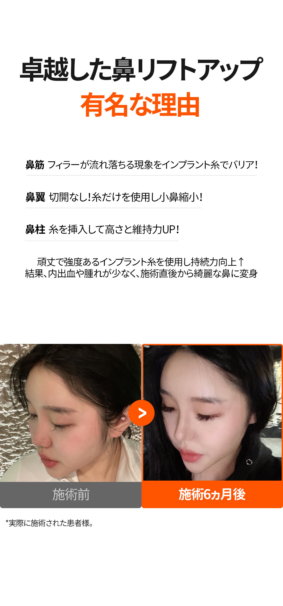 Nâng mũi không dao Nose Thread Lift | Thủ thuật 15 phút giảm downtime | Elne Clinic ga Gangnam, Seoul