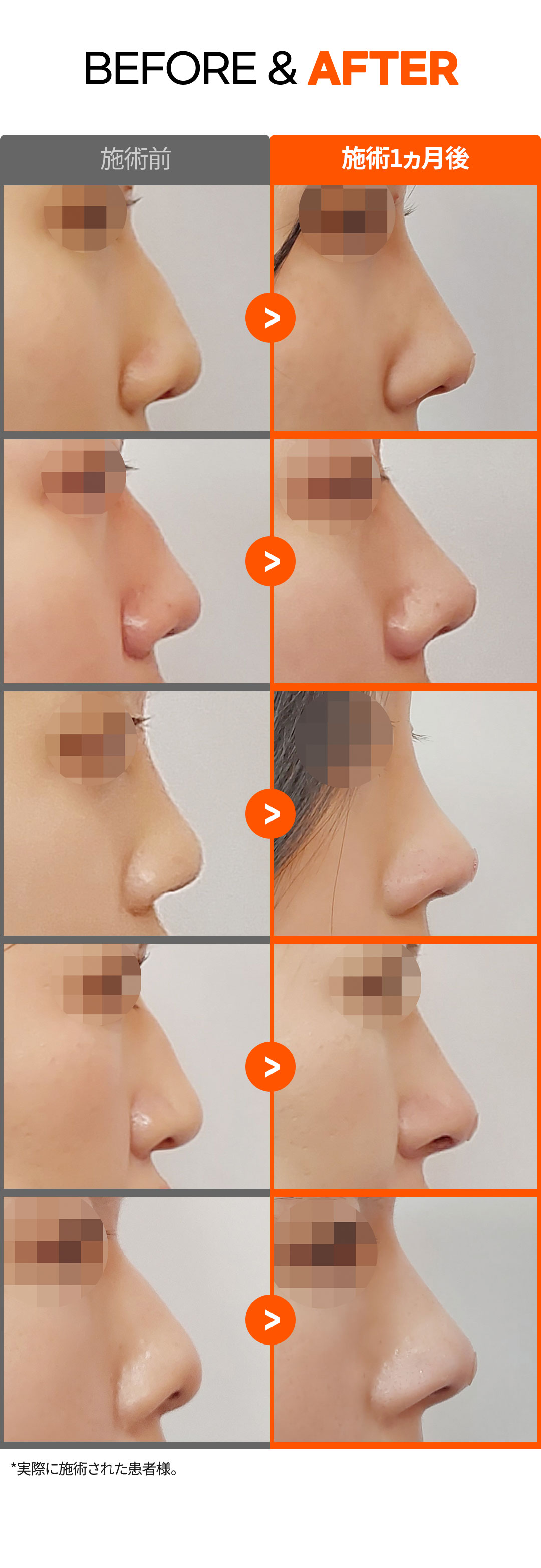 Nâng mũi không dao Nose Thread Lift | Thủ thuật 15 phút giảm downtime | Elne Clinic ga Gangnam, Seoul