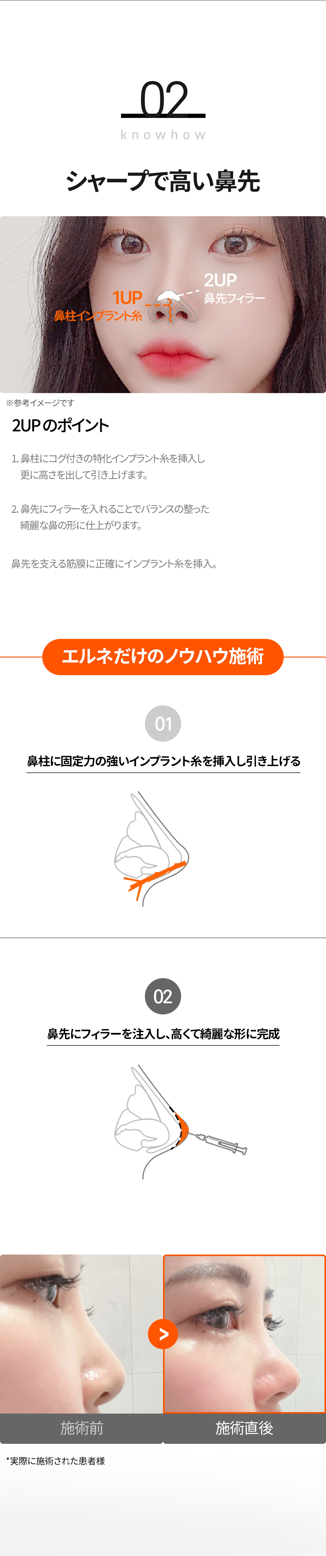 Nâng mũi không dao Nose Thread Lift | Thủ thuật 15 phút giảm downtime | Elne Clinic ga Gangnam, Seoul