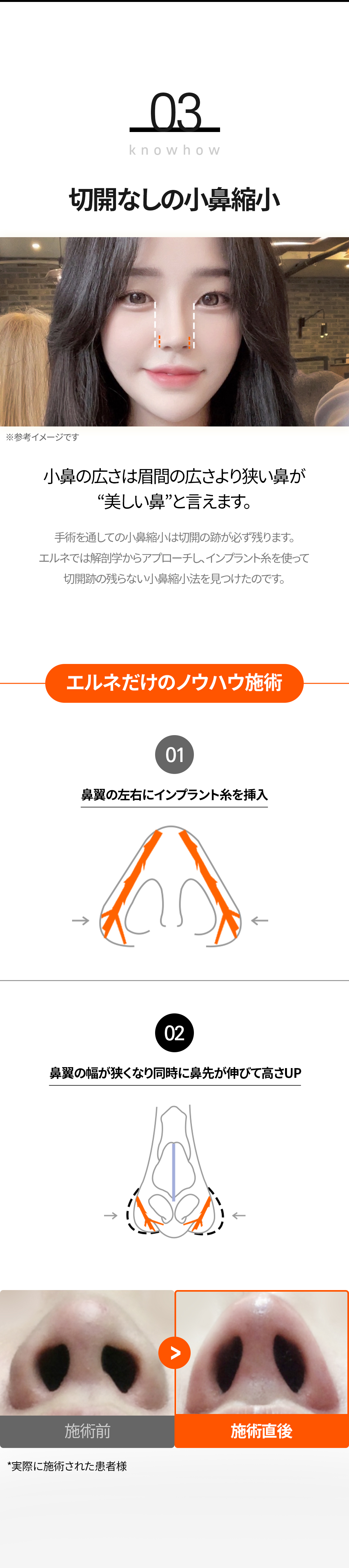 Nâng mũi không dao Nose Thread Lift | Thủ thuật 15 phút giảm downtime | Elne Clinic ga Gangnam, Seoul