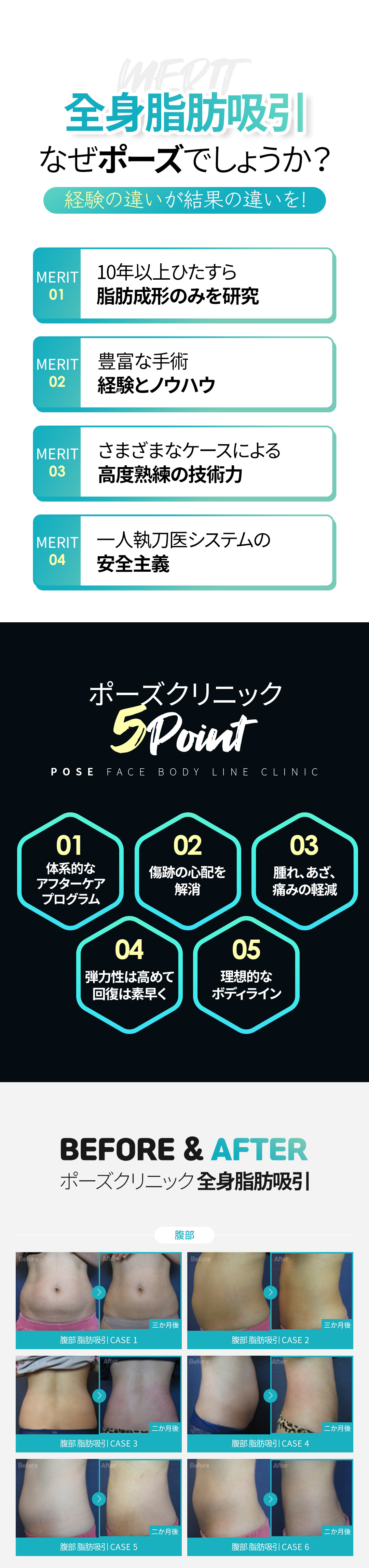 Hút mỡ toàn thân Multi Plus | Hút 360 độ tạo đường cong cơ thể lý tưởng | Pose Clinic Gangnam