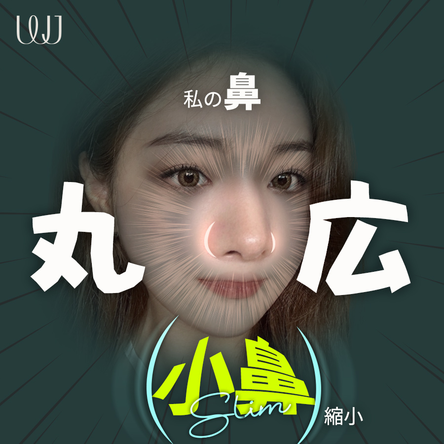 Phẫu thuật thu nhỏ cánh mũi không cắt | WJ Wonjin Thẩm mỹ | Hướng tới cải thiện cánh mũi tự nhiên cách ga Gangnam 3 phút đi bộ