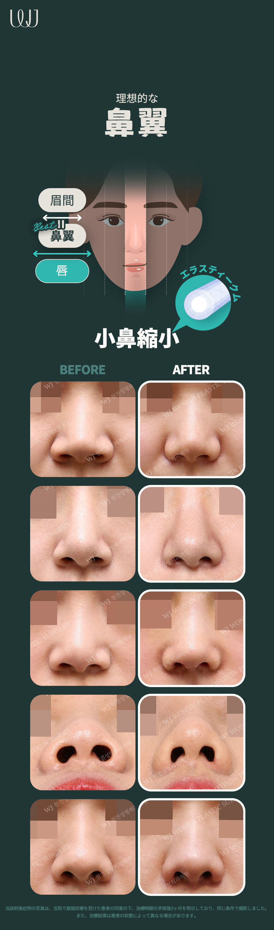 Phẫu thuật thu nhỏ cánh mũi không cắt | WJ Wonjin Thẩm mỹ | Hướng tới cải thiện cánh mũi tự nhiên cách ga Gangnam 3 phút đi bộ