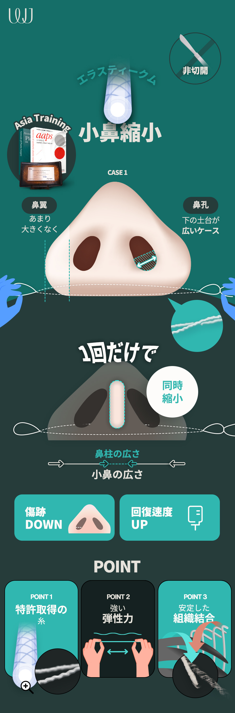 Phẫu thuật thu nhỏ cánh mũi không cắt | WJ Wonjin Thẩm mỹ | Hướng tới cải thiện cánh mũi tự nhiên cách ga Gangnam 3 phút đi bộ