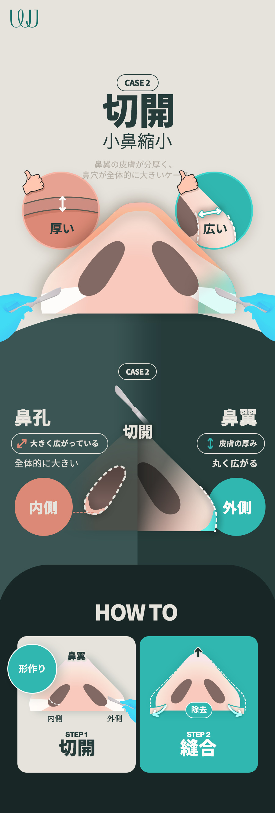 Phẫu thuật thu nhỏ cánh mũi không cắt | WJ Wonjin Thẩm mỹ | Hướng tới cải thiện cánh mũi tự nhiên cách ga Gangnam 3 phút đi bộ