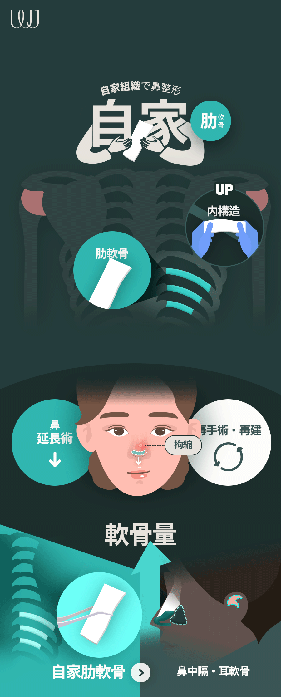 Phẫu thuật mũi sụn sườn tự thân | Thủ thuật hướng tới đường mũi tự nhiên không dùng prosthesis | WJ Wonjin Thẩm mỹ Gangnam