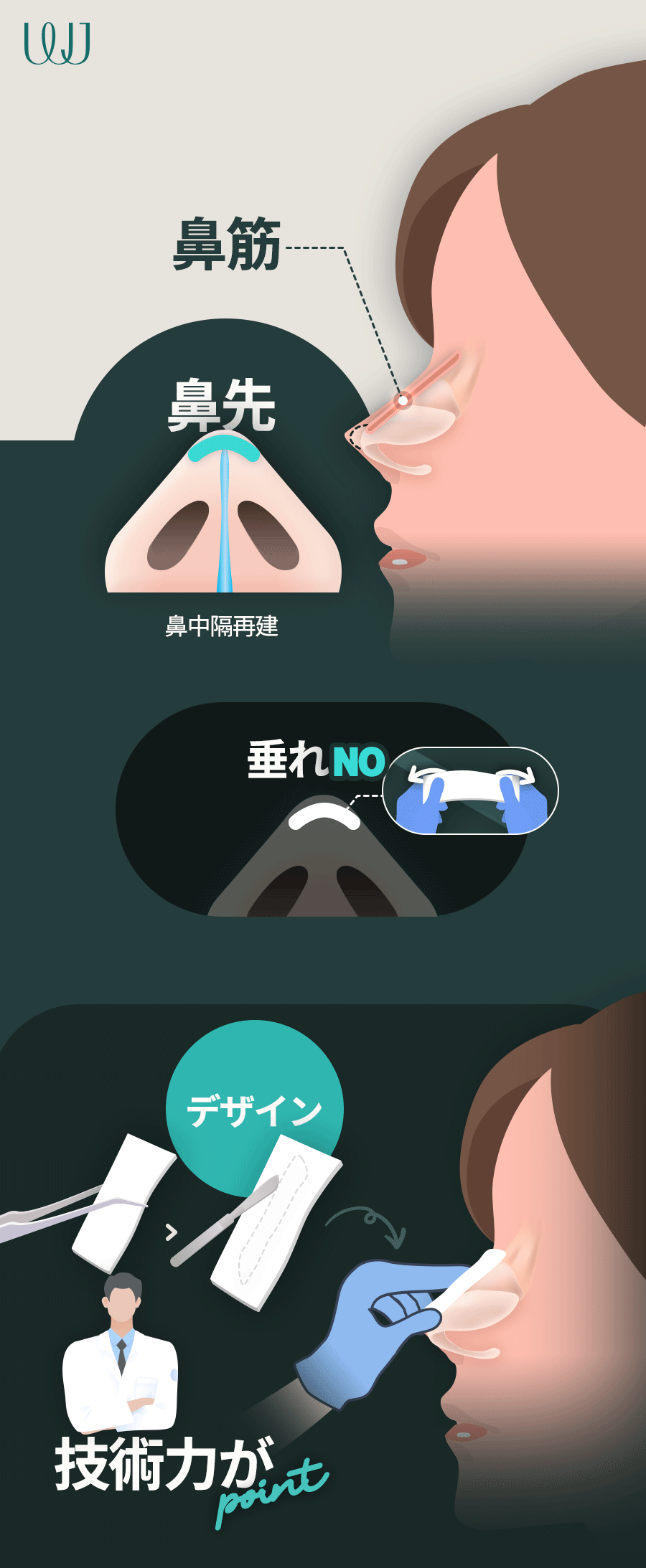 Phẫu thuật mũi sụn sườn tự thân | Thủ thuật hướng tới đường mũi tự nhiên không dùng prosthesis | WJ Wonjin Thẩm mỹ Gangnam