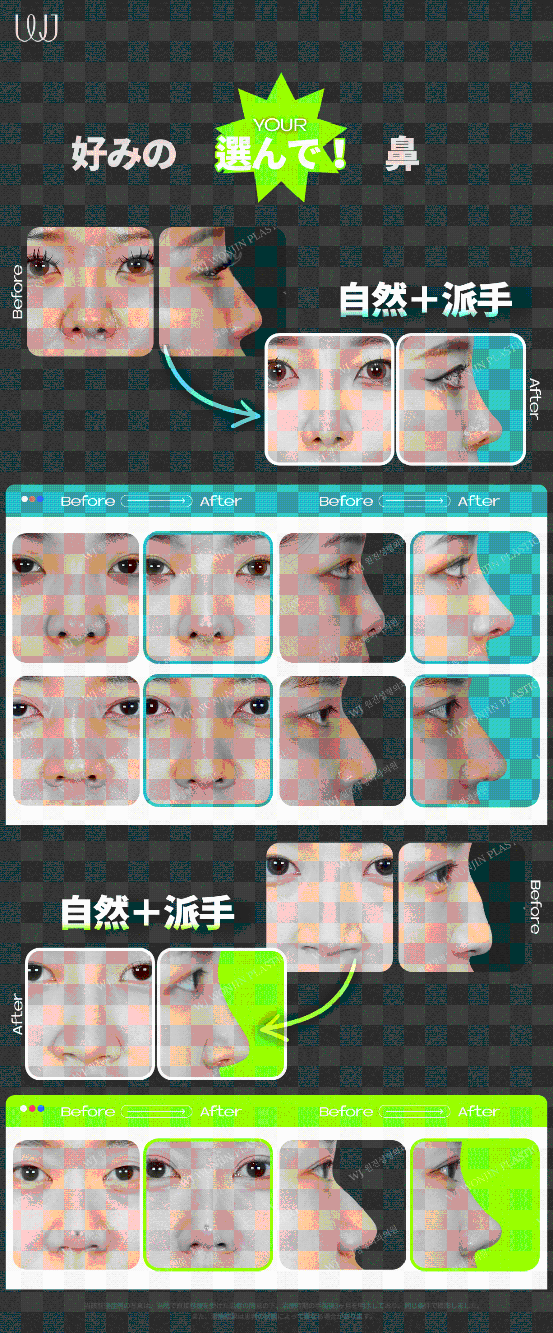 Phẫu thuật mũi sụn sườn tự thân | Thủ thuật hướng tới đường mũi tự nhiên không dùng prosthesis | WJ Wonjin Thẩm mỹ Gangnam