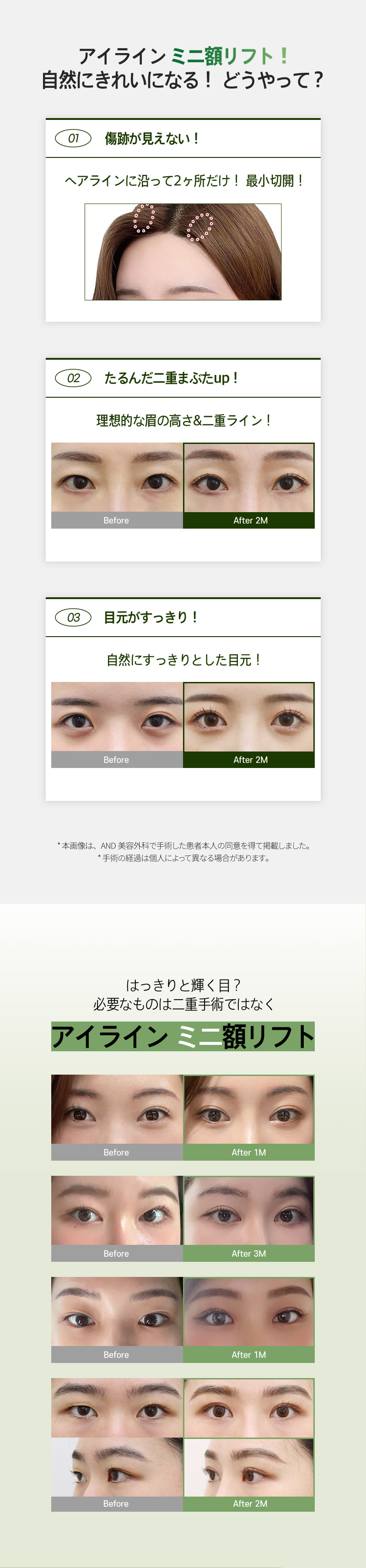 Eyeline Mini Forehead Lift | Điều trị rạch tối thiểu hướng đến trẻ hóa vùng mắt | AND Clinic Gangnam Hàn Quốc