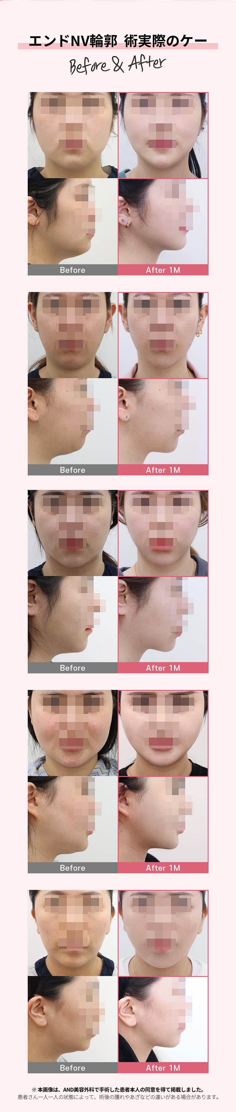 Phẫu thuật NV Contour (hút mỡ mặt) cải thiện đường viền khuôn mặt | AND Sinnonhyeon Seoul