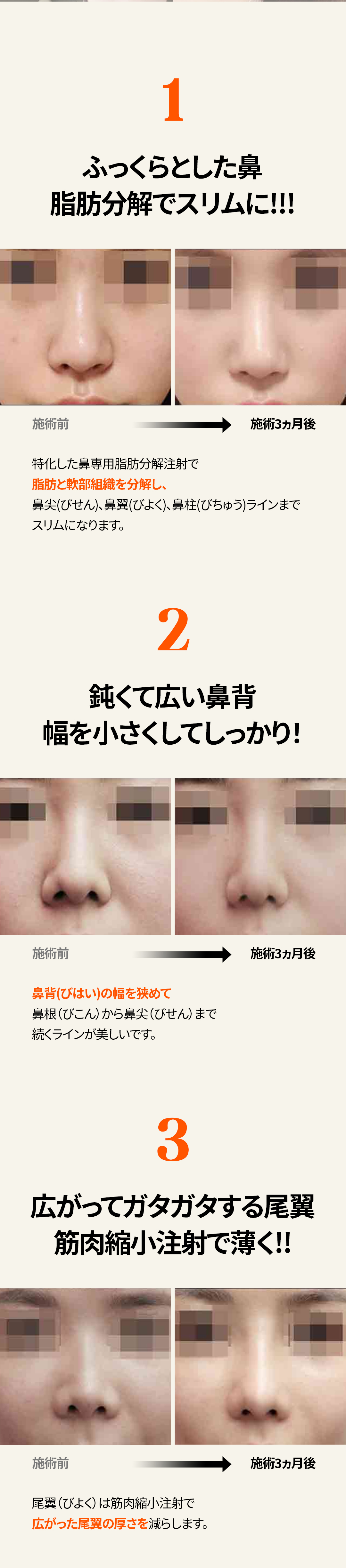 Tiêm điêu khắc mũi để hướng đến đường mũi lý tưởng | Chỉnh mũi không cắt・Phân giải mỡ × Thu nhỏ cơ | Seoul Gangnam stn.・Phòng khám Elne