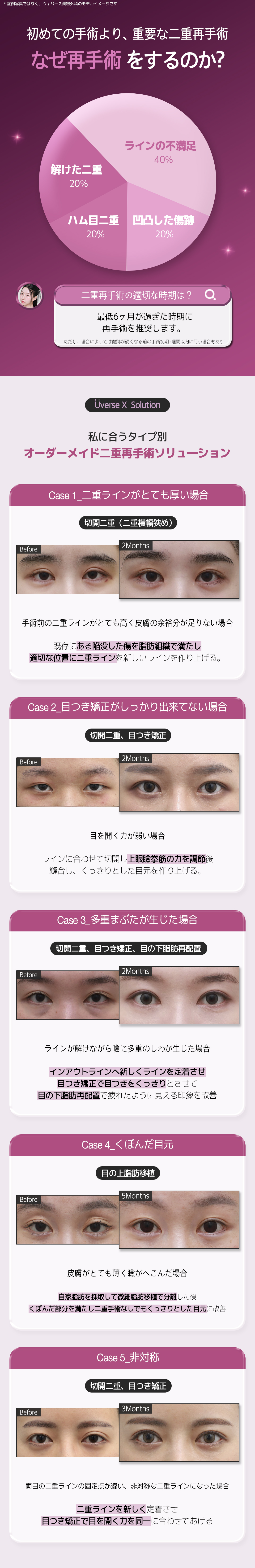 Hướng đến vùng mắt tự nhiên với phẫu thuật lại mí đôi (Phương pháp rạch)｜Điều trị đặt hàng từng người｜Weavers Thẩm mỹ ga Gangnam