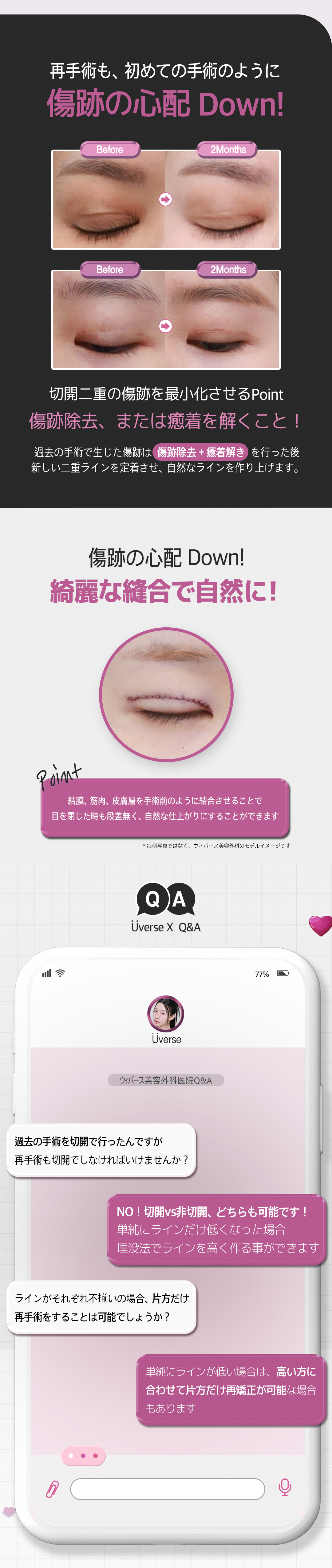 Hướng đến vùng mắt tự nhiên với phẫu thuật lại mí đôi (Phương pháp rạch)｜Điều trị đặt hàng từng người｜Weavers Thẩm mỹ ga Gangnam