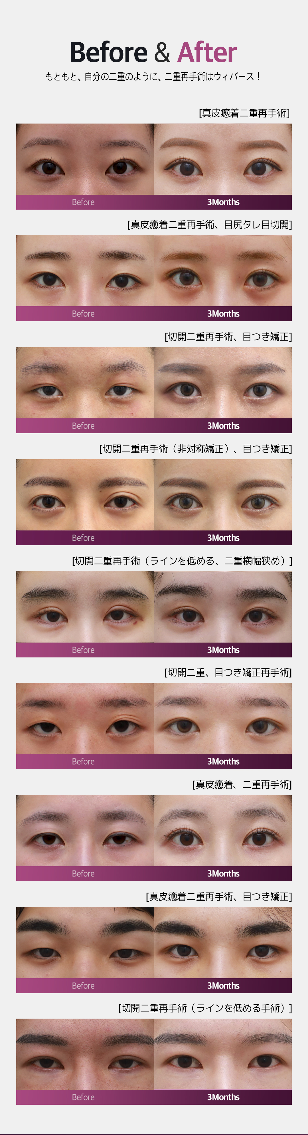 Hướng đến vùng mắt tự nhiên với phẫu thuật lại mí đôi (Phương pháp rạch)｜Điều trị đặt hàng từng người｜Weavers Thẩm mỹ ga Gangnam