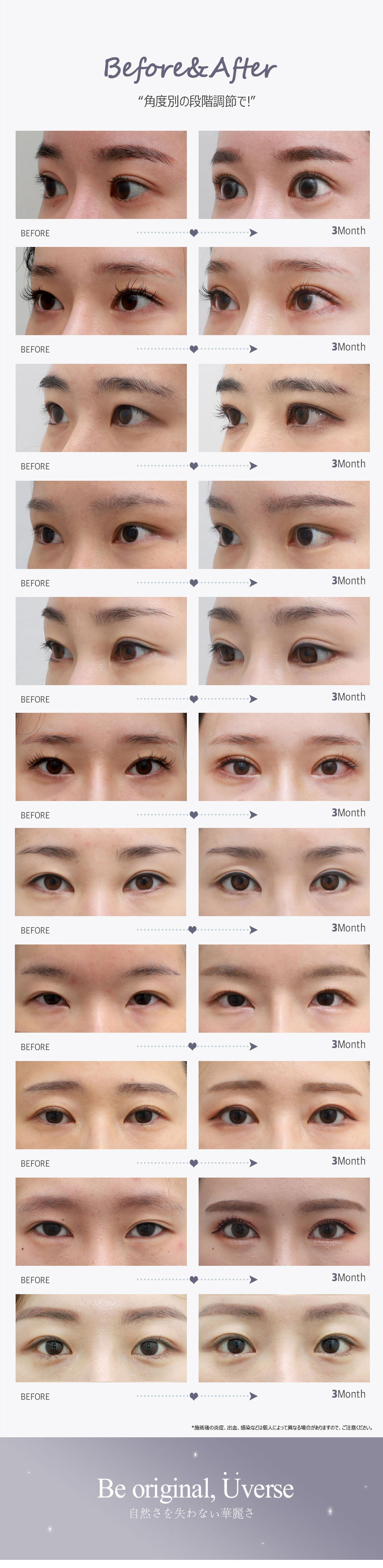 Rạch góc đuôi mắt Weavers