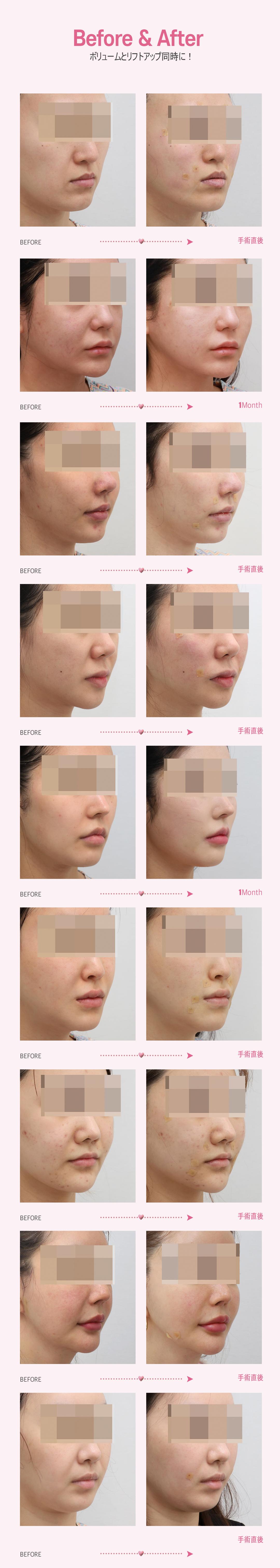 Peach Thread Lift Weavers Plastic Surgery Hàn Quốc | Hướng tới liftup tự nhiên bằng tiếp cận đa tầng・đa hướng | Ga Gangnam