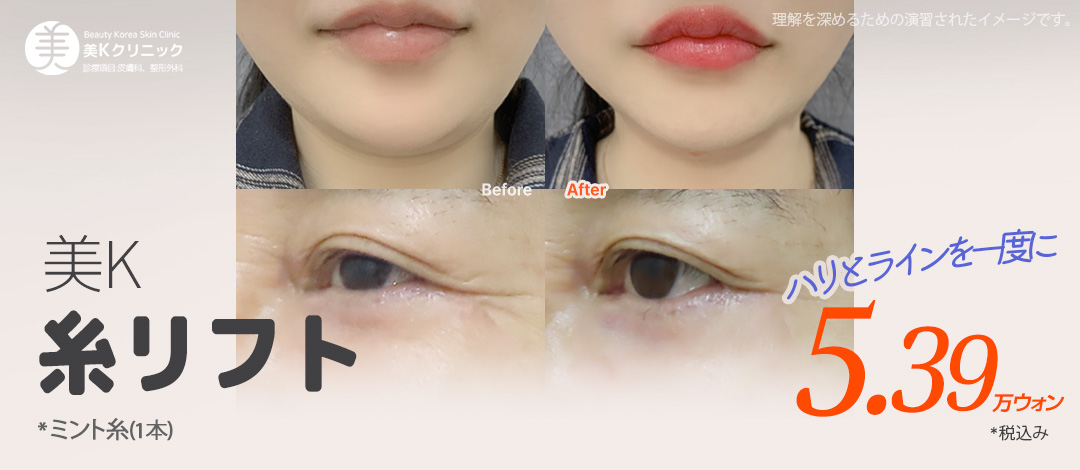 Chỉ nâng tại Phòng khám Mi K ga Gangnam | Chỉ Mint cải thiện rãnh mũi má và chảy xệ | Từ 5,835 Yên