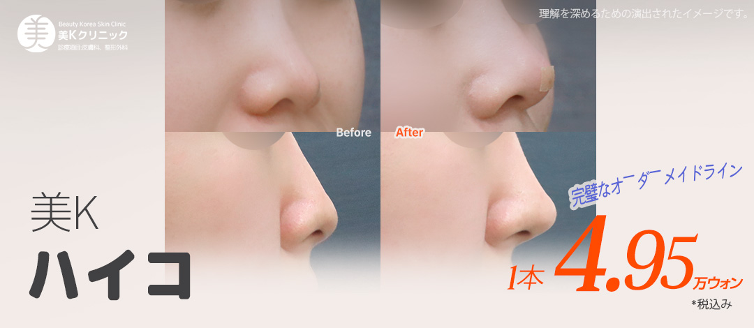 Nâng mũi bằng chỉ Mint Hiko | Tạo dáng mũi tự nhiên không cần phẫu thuật | Phòng khám Mi K ga Gangnam