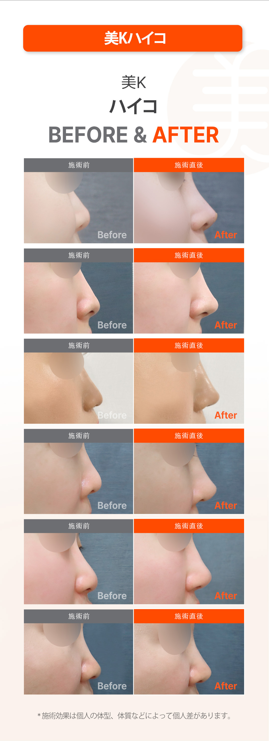 Nâng mũi bằng chỉ Mint Hiko | Tạo dáng mũi tự nhiên không cần phẫu thuật | Phòng khám Mi K ga Gangnam