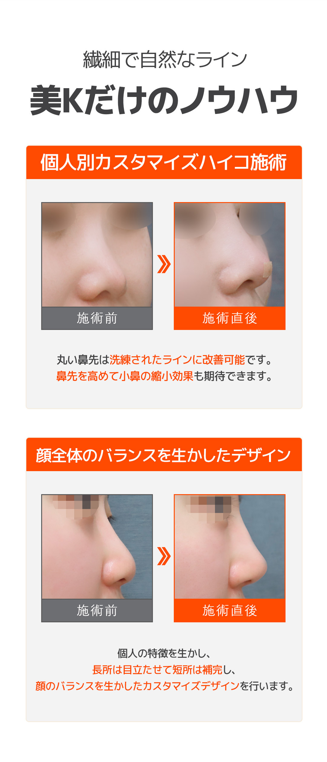 Nâng mũi bằng chỉ Mint Hiko | Tạo dáng mũi tự nhiên không cần phẫu thuật | Phòng khám Mi K ga Gangnam