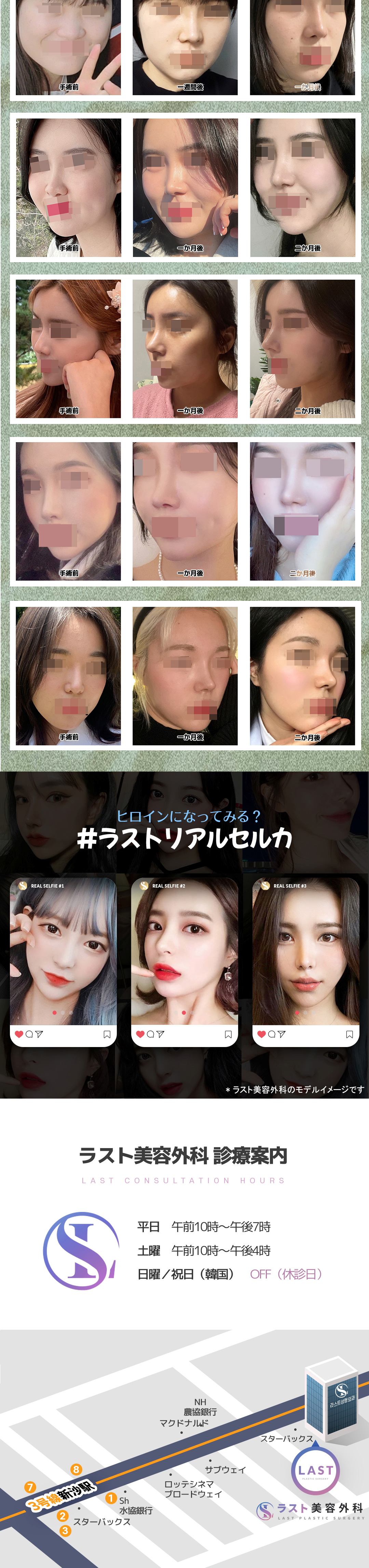 Nâng mũi All Line | Nâng mũi hướng tới đường nét mũi tự nhiên phù hợp với từng người | Seoul Sinsa stn.・Last Phẫu thuật Thẩm mỹ