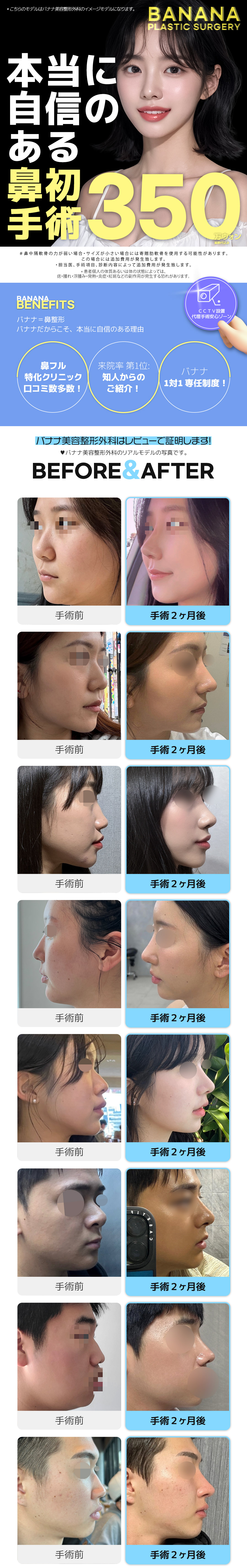 Phẫu thuật mũi lần đầu | Banana Plastic Surgery | Cách ga Sinsa 1 phút - Phẫu thuật thẩm mỹ Hàn Quốc nhằm sống mũi tự nhiên bằng chẩn đoán 3DCT