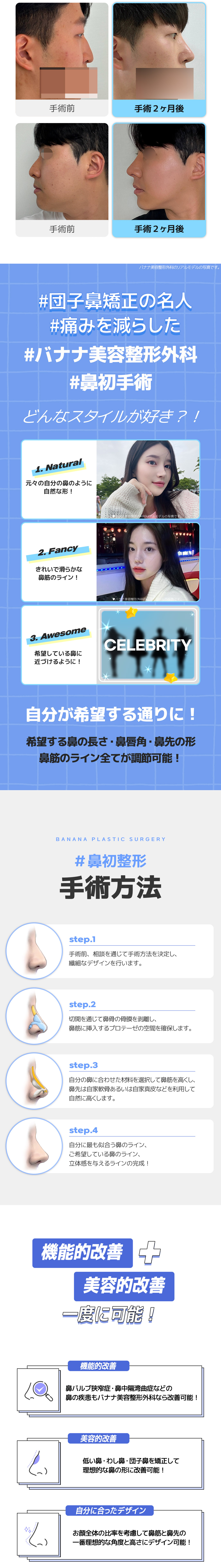 Phẫu thuật mũi lần đầu | Banana Plastic Surgery | Cách ga Sinsa 1 phút - Phẫu thuật thẩm mỹ Hàn Quốc nhằm sống mũi tự nhiên bằng chẩn đoán 3DCT