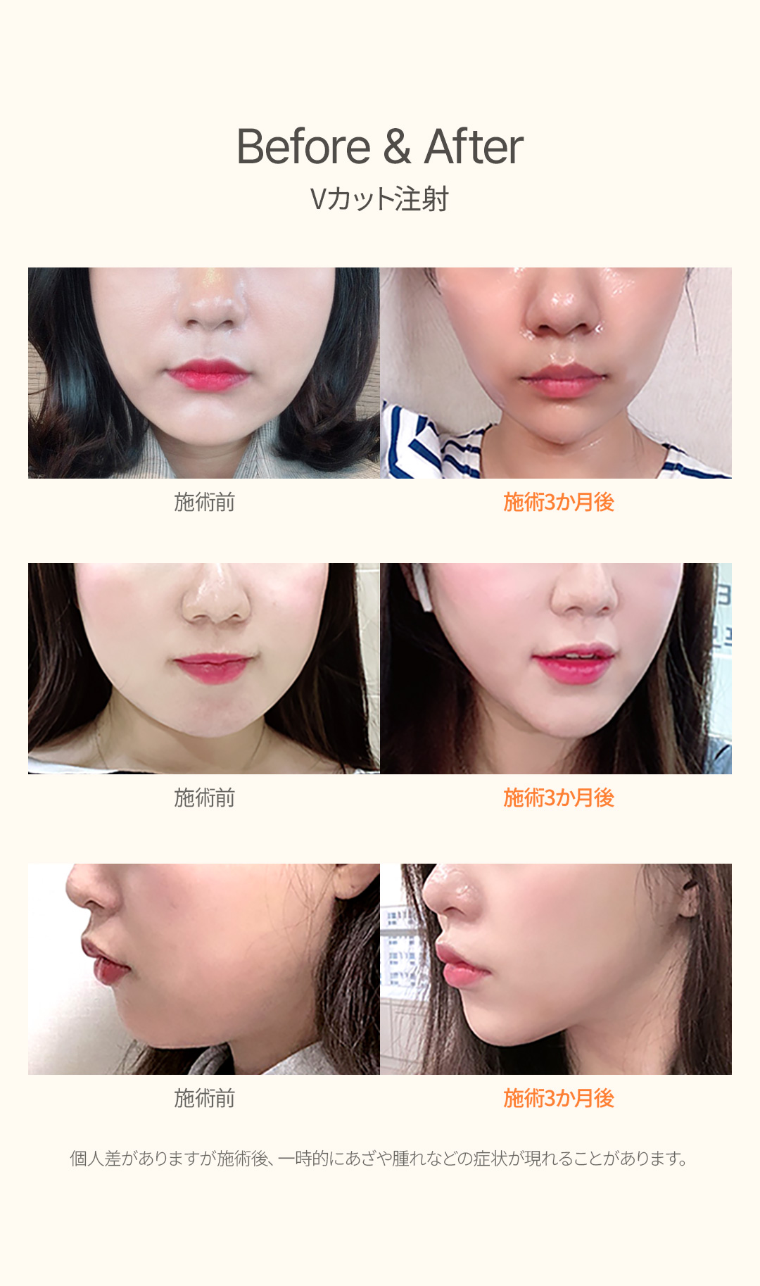 Uline Clinic Hàn Quốc | Tiêm V Cut (tan mỡ) nhằm cải thiện đường viền khuôn mặt | Apgujeong, Gangnam