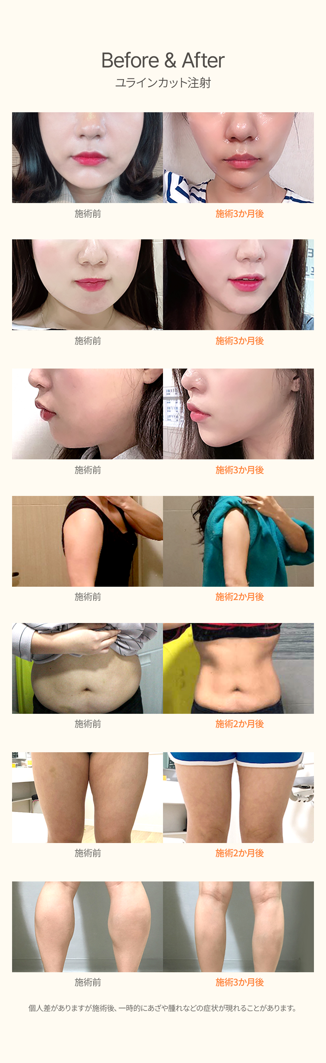 Tiêm Cut tại Uline Clinic | Tiêm tan mỡ đã cấp bằng sáng chế Mỹ-Hàn nhằm cải thiện đường nét cơ thể | Apgujeong