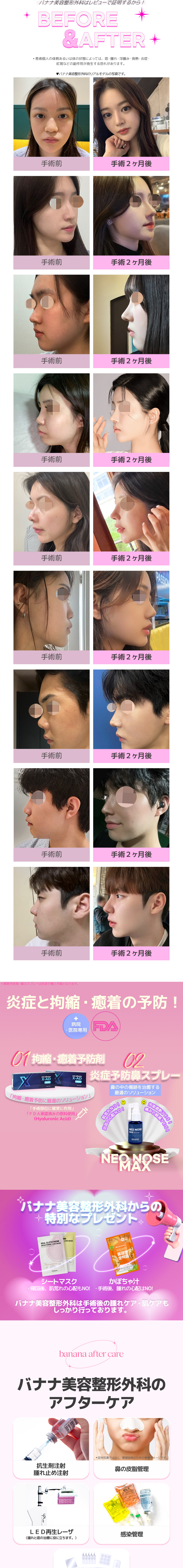 Chuyên phẫu thuật lại mũi | Hướng tới mũi lý tưởng với chẩn đoán chính xác 3DCT × túi độn theo đơn đặt hàng | Seoul Sinsa Banana Phẫu thuật Tạo hình Thẩm mỹ