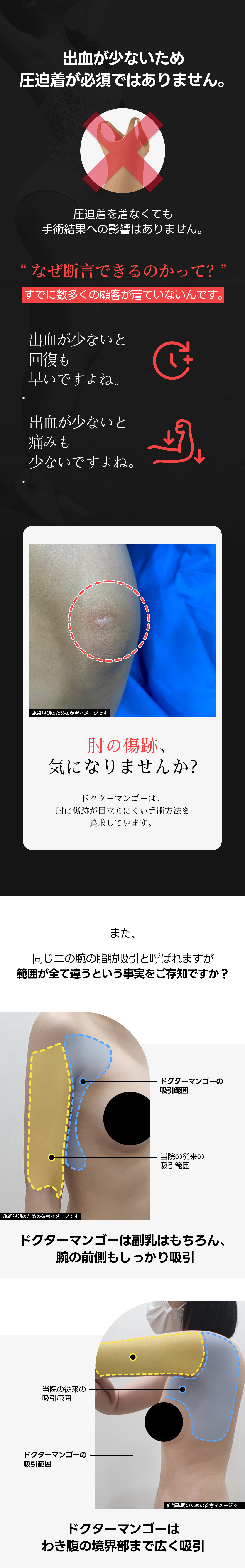 Hút mỡ bắp tay | Thủ thuật chú ý đến sẹo bằng kỹ thuật thủ công 100% | Dr. Mango Clinic Gangnam