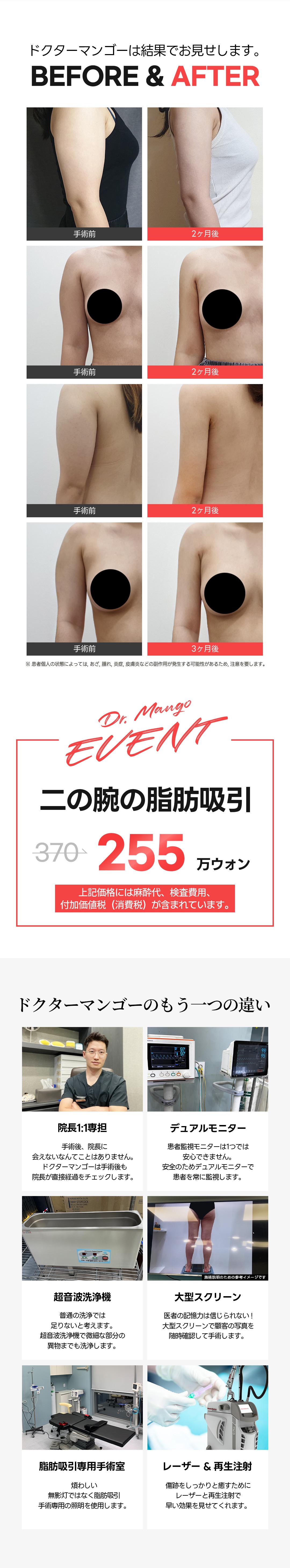 Hút mỡ bắp tay | Thủ thuật chú ý đến sẹo bằng kỹ thuật thủ công 100% | Dr. Mango Clinic Gangnam