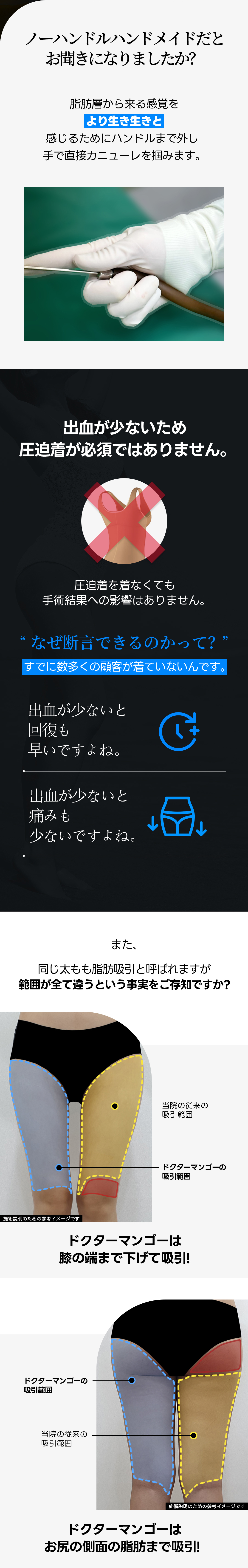 Hút mỡ đùi | Đường viền mịn màng bằng kỹ thuật 100% Handmade | Phòng khám Doctor Mango Seoul Gangnam