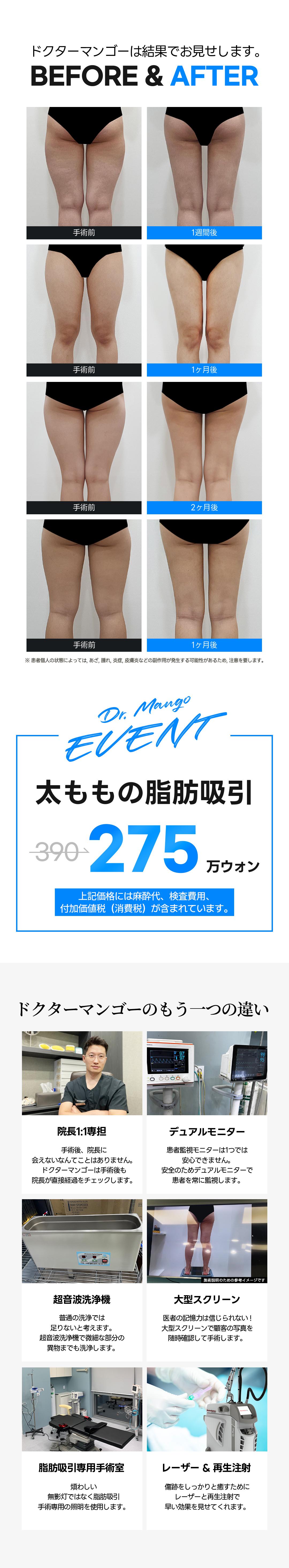 Hút mỡ đùi | Đường viền mịn màng bằng kỹ thuật 100% Handmade | Phòng khám Doctor Mango Seoul Gangnam