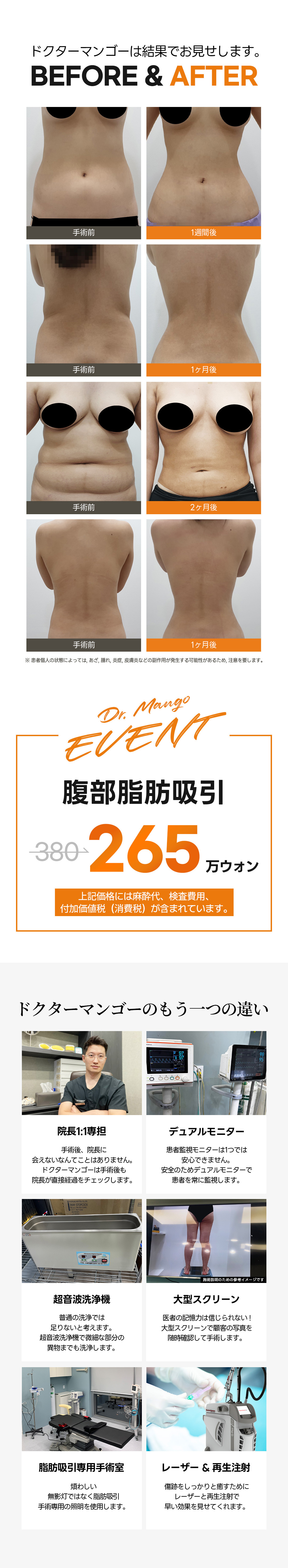 Hàn Quốc Gangnam | Hướng đến đường cong cơ thể mịn màng bằng hút mỡ bụng Handmade | Phòng khám Doctor Mango