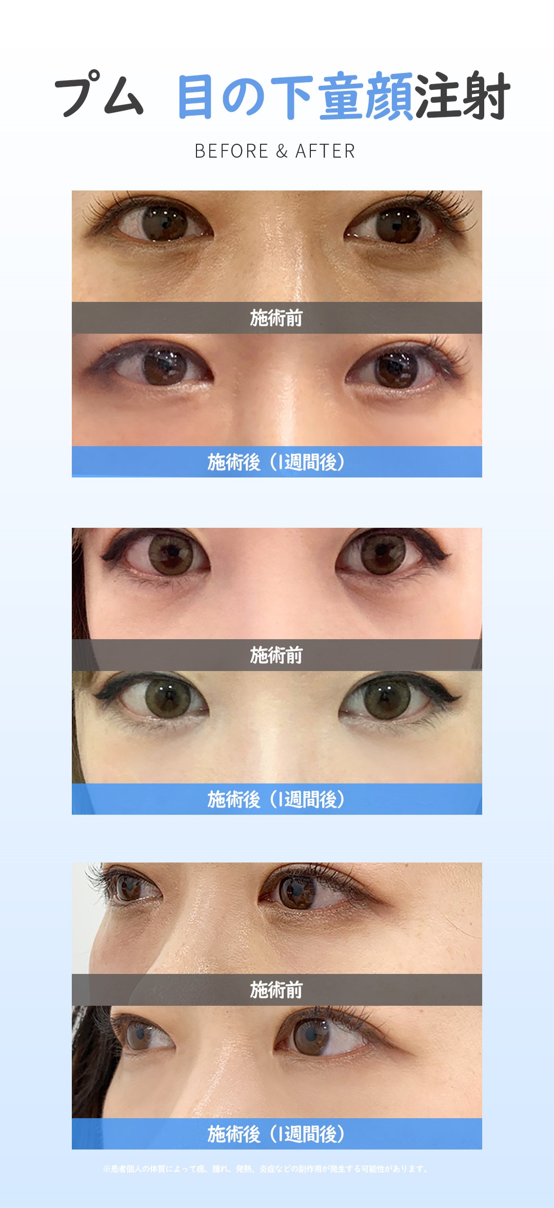 Tiêm đồng nhan dưới mắt hướng đến vùng mắt tươi sáng | Điều trị 5-10 phút không phẫu thuật | Poom Global Clinic Myeongdong (11,790 yên)