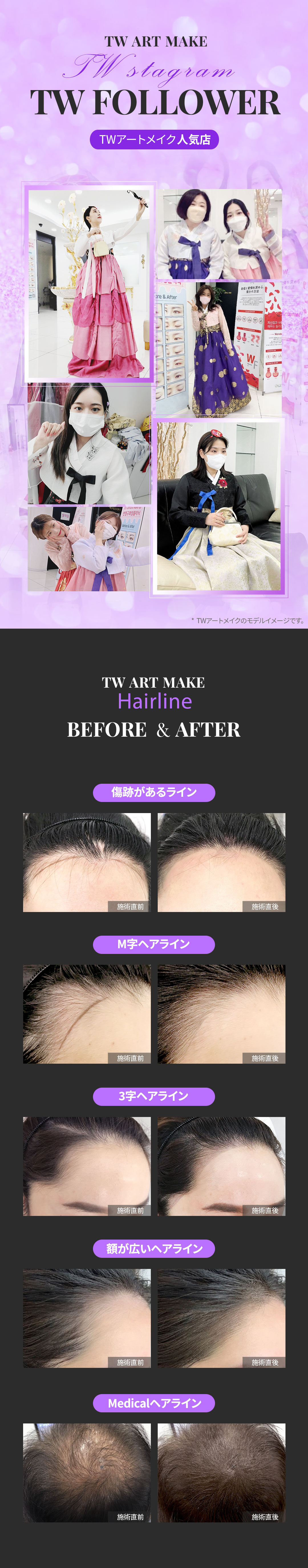 Phun xăm đường chân tóc tại TW Sekaji Sowon Clinic | Yên tâm với nhân viên Nhật Bản thường trực tại Myeongdong