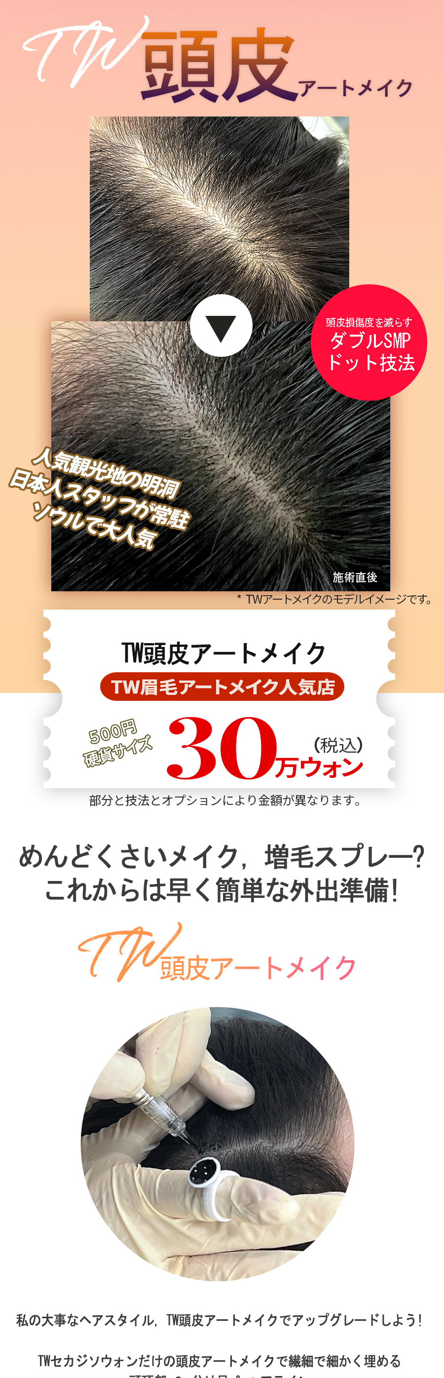 Phun xăm da đầu | Myeongdong Sekaji Sowon Clinic | Điều trị che phủ tóc thưa với nhân viên Nhật thường trực