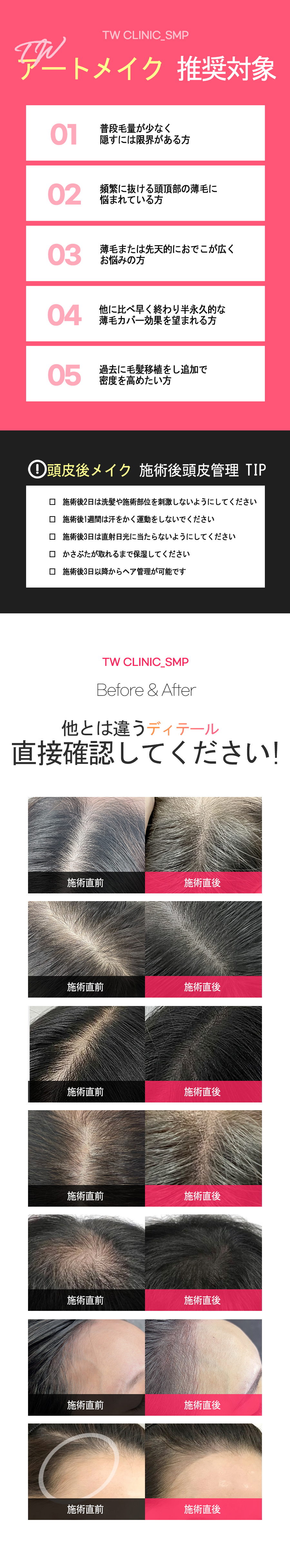 Phun xăm da đầu | Myeongdong Sekaji Sowon Clinic | Điều trị che phủ tóc thưa với nhân viên Nhật thường trực