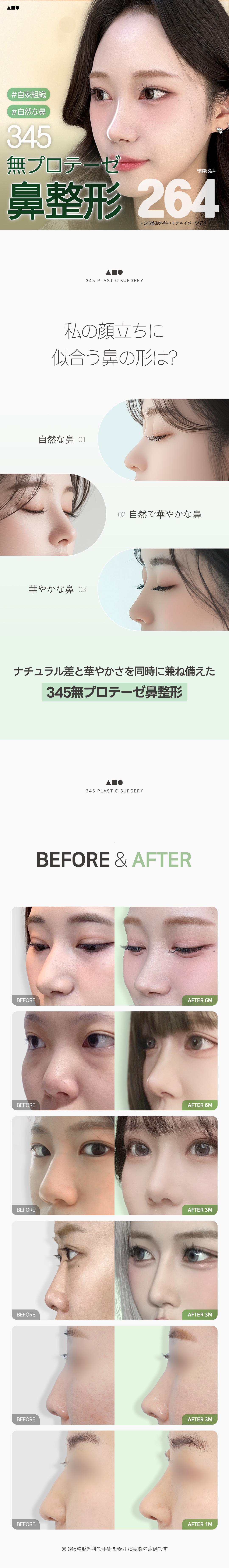 Phẫu thuật mũi mô tự thân Seoul Hàn Quốc | Hướng tới mũi tự nhiên không dùng prosthesis | Sinnonhyeon・345 Thẩm mỹ