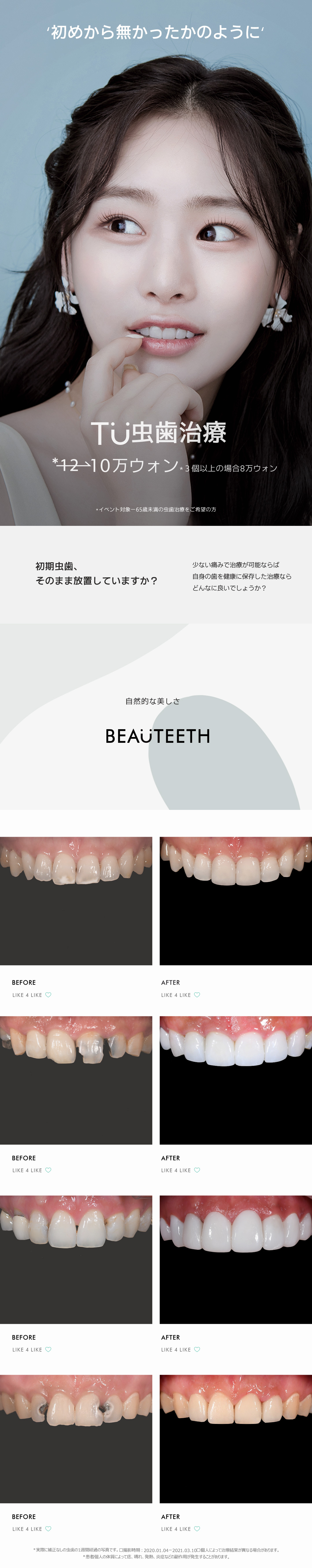 Hàn Quốc・Ga Gangnam TU Dental Điều trị sâu răng | Điều trị cẩn thận chú trọng bảo tồn răng tự nhiên với chẩn đoán 3D chính xác