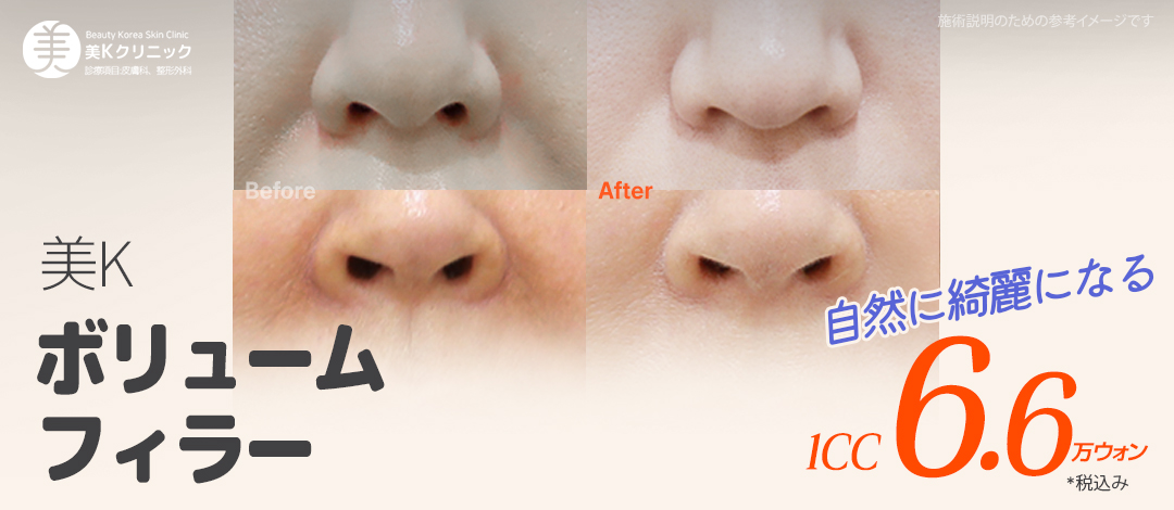 Mikei Clinic ga Gangnam Hàn Quốc | Thủ thuật Volume Filler (môi, cằm, rãnh mũi má) Thủ thuật custom 1:1 nhằm kết quả tự nhiên