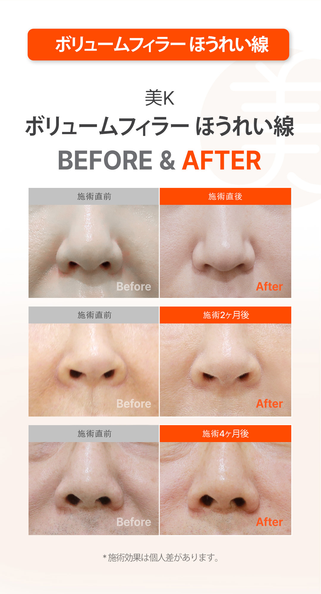 Mikei Clinic ga Gangnam Hàn Quốc | Thủ thuật Volume Filler (môi, cằm, rãnh mũi má) Thủ thuật custom 1:1 nhằm kết quả tự nhiên