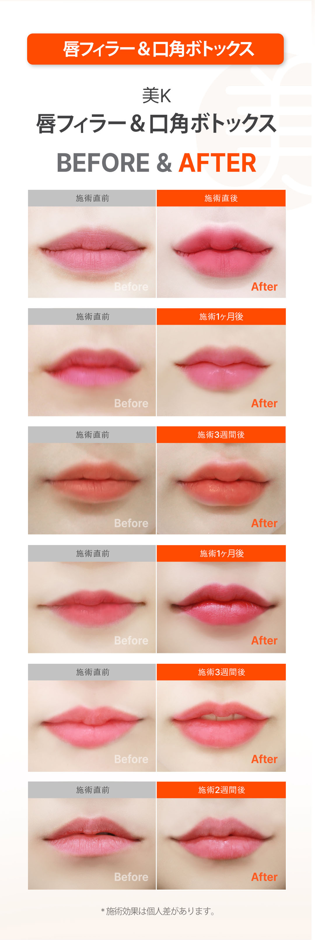 Mikei Clinic ga Gangnam Hàn Quốc | Thủ thuật Volume Filler (môi, cằm, rãnh mũi má) Thủ thuật custom 1:1 nhằm kết quả tự nhiên