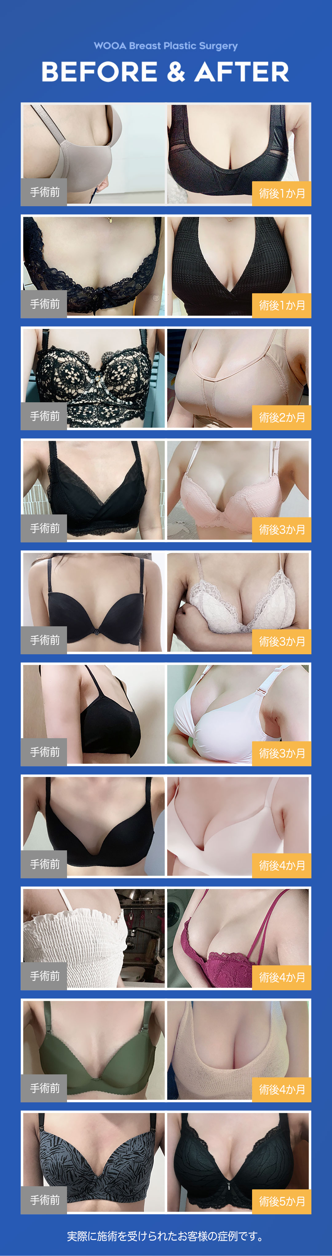 Phẫu thuật nâng ngực phương pháp ba mặt phẳng của Wooa Plastic Surgery Hàn Quốc | Nâng ngực hướng tới kết quả tự nhiên và ít di chuyển | Gangnam