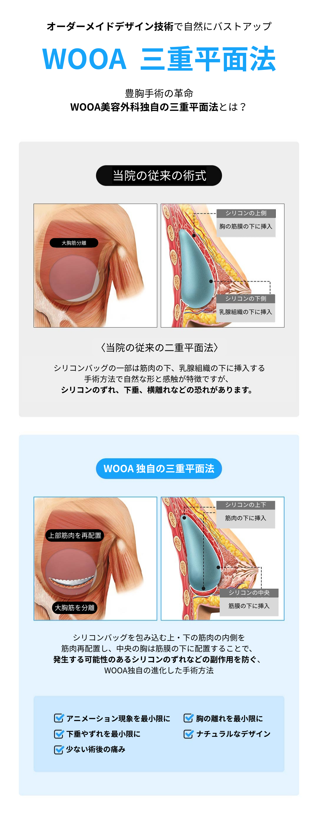 Phẫu thuật nâng ngực phương pháp ba mặt phẳng của Wooa Plastic Surgery Hàn Quốc | Nâng ngực hướng tới kết quả tự nhiên và ít di chuyển | Gangnam