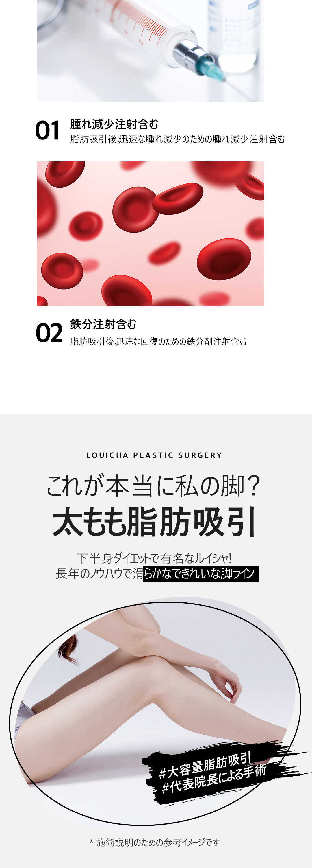 Hút mỡ đùi 360 độ｜Seoul Cheongdam Luixa Clinic｜Thủ thuật dung lượng lớn hướng tới đường viền chân thon gọn