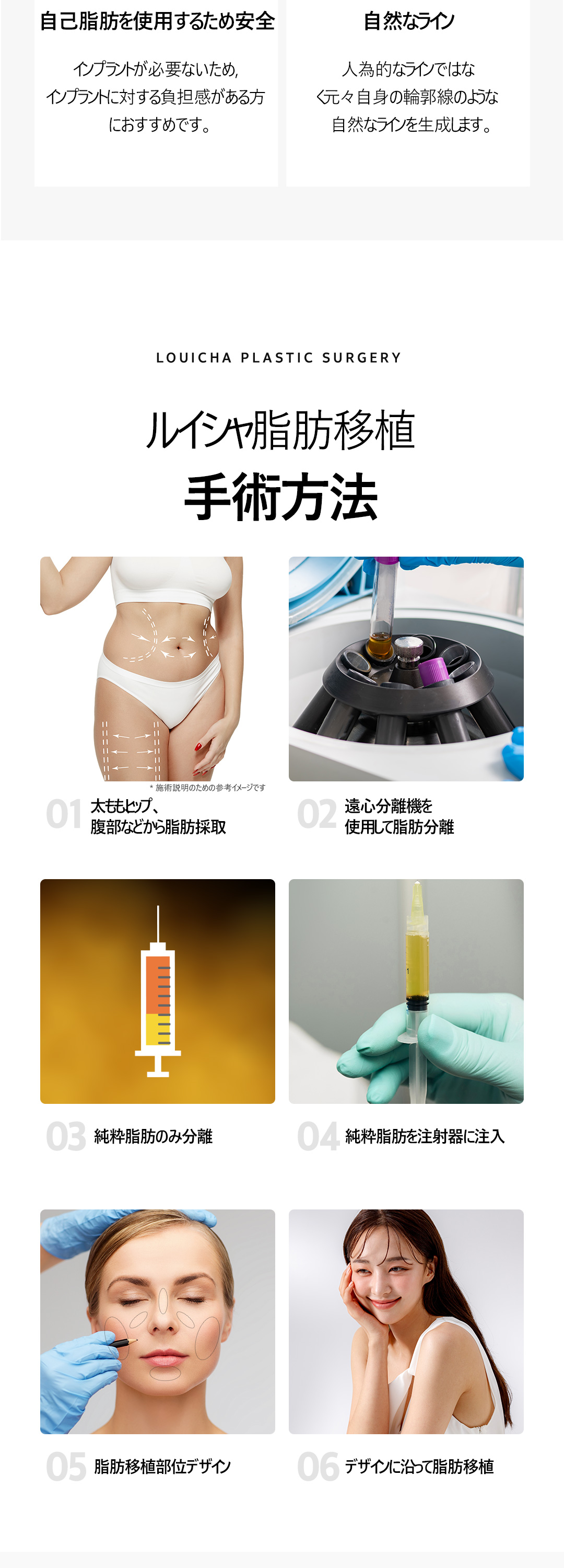 Ghép mỡ mặt + PRP｜Hướng tới volume tự nhiên bằng mỡ tự thân｜Luixa Clinic【Gangnam】