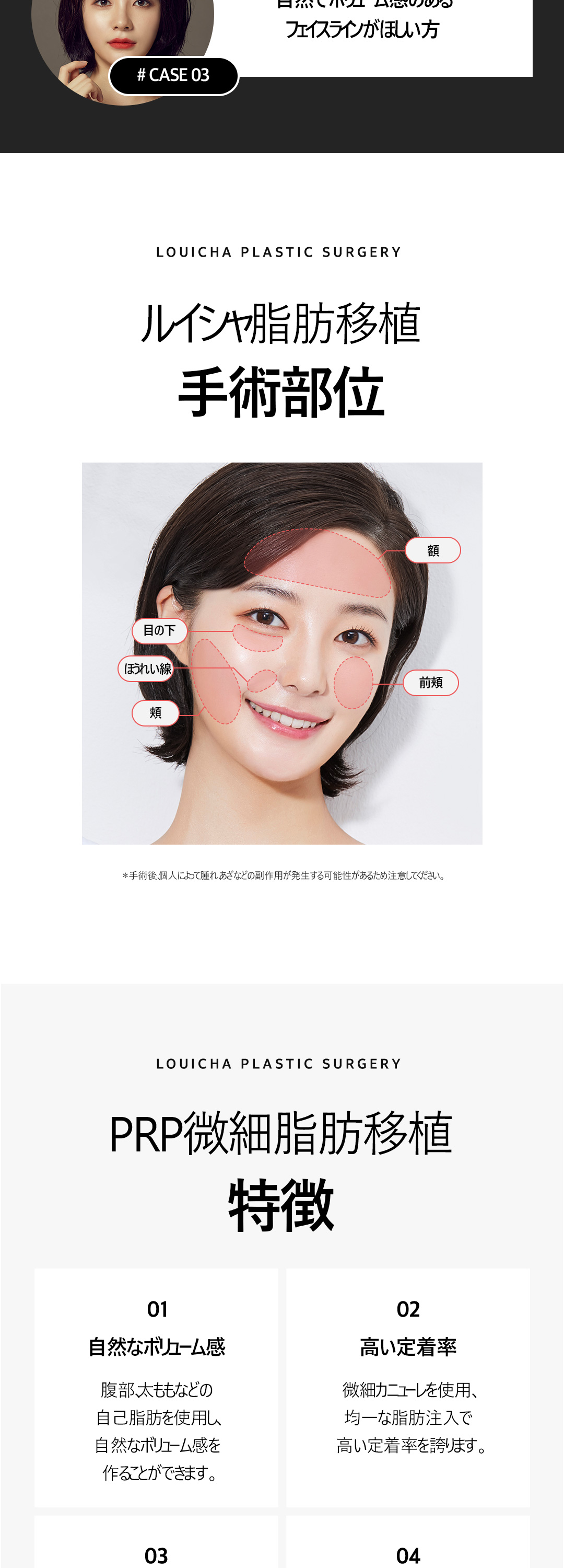 Ghép mỡ mặt + PRP｜Hướng tới volume tự nhiên bằng mỡ tự thân｜Luixa Clinic【Gangnam】