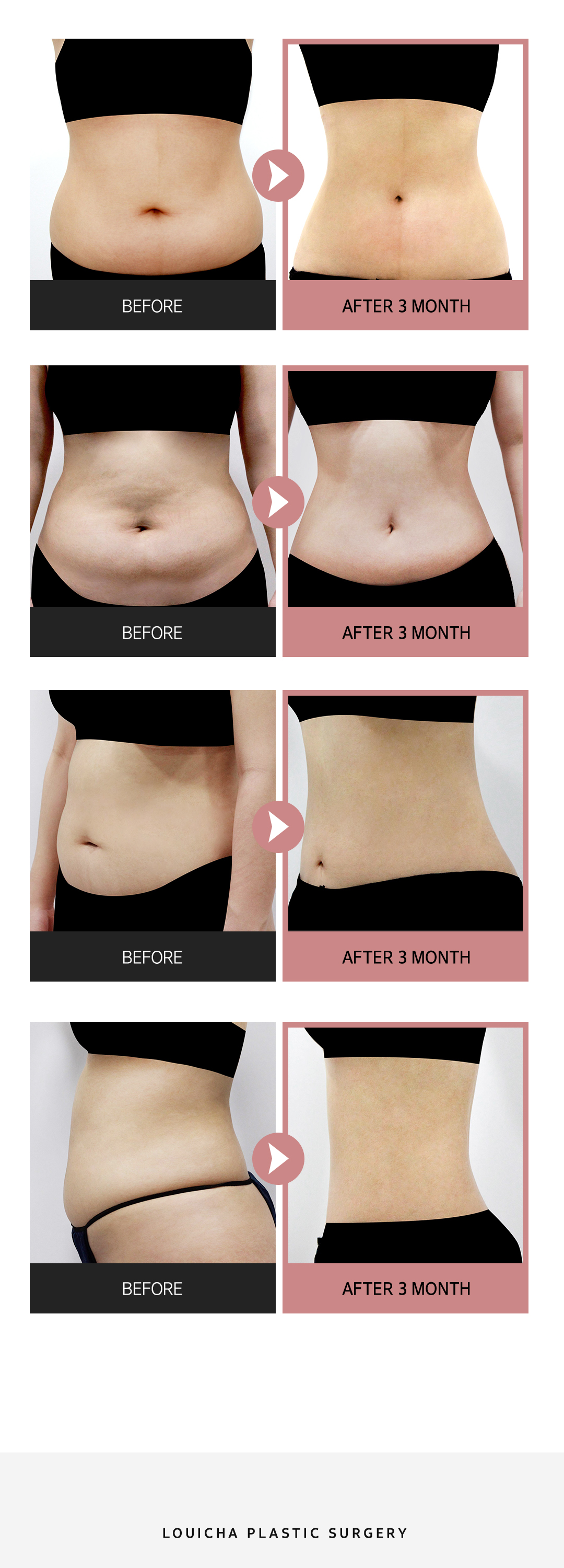 Hút mỡ bụng Louise Clinic Gangnam Hàn Quốc | Hút mỡ nguyên chất hướng đến body line lý tưởng | Hỗ trợ dung lượng lớn